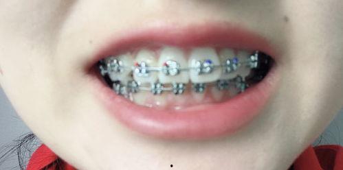 成人矫正牙龈的方法视频,专业视频教程解析