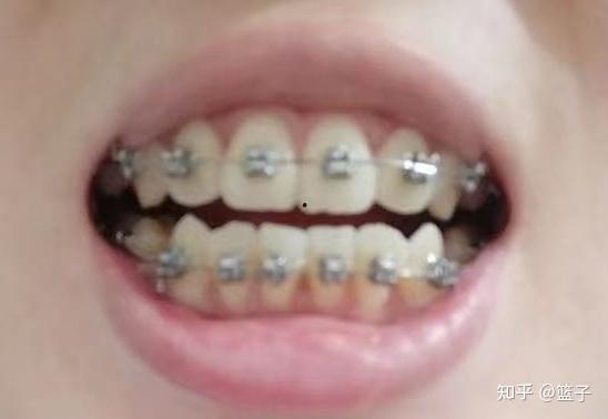 成人矫正牙龈的方法视频,专业视频教程解析