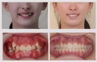 成人矫正牙龈的方法视频,专业视频教程解析